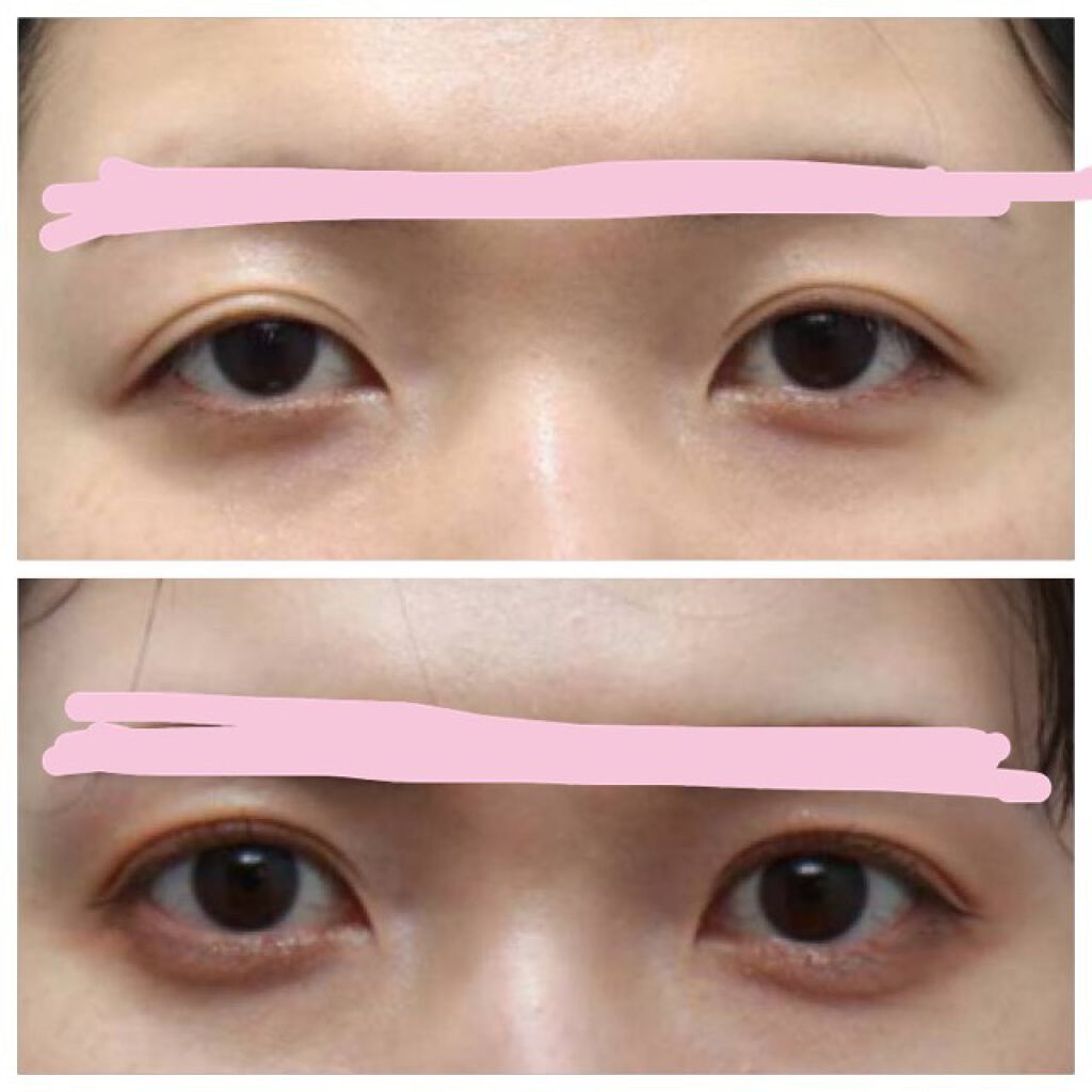 二重整形/その他を使ったクチコミ（3枚目）