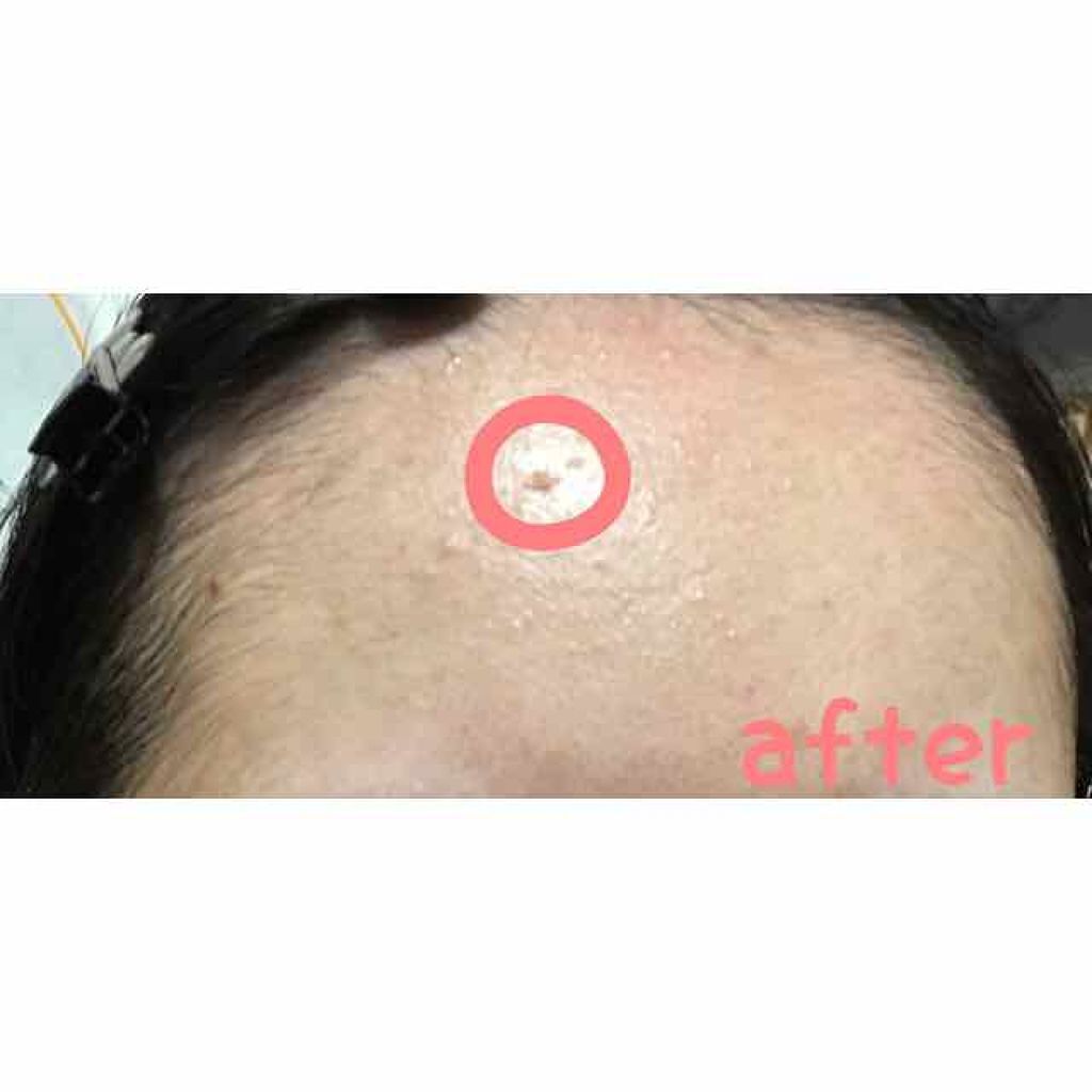 アットノンEX ジェル(医薬品)/アットノン/その他を使ったクチコミ(3枚目)