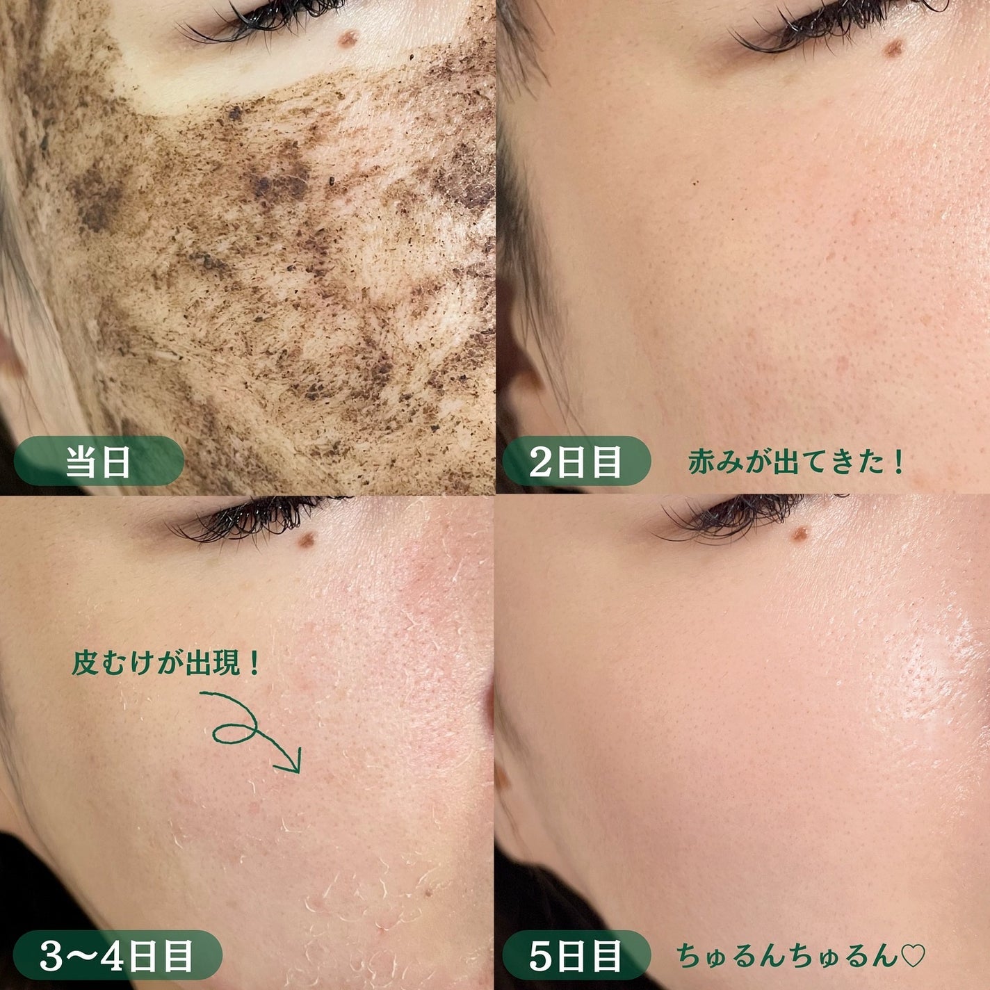 ダーマスキンピーリング/BQCELL/その他キットセットを使ったクチコミ(4枚目)