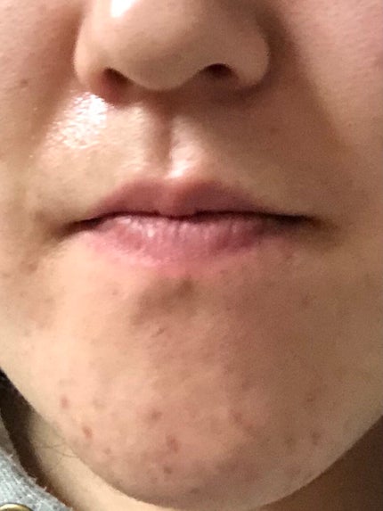 あっすー on LIPS 「ニキビを少しでも減らす方法!!・ニキビが気になる人は使う商品を..」(4枚目)