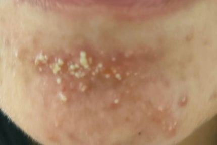 レッドブレミッシュ クリアスージングクリーム/Dr.G/フェイスクリームを使ったクチコミ(2枚目)