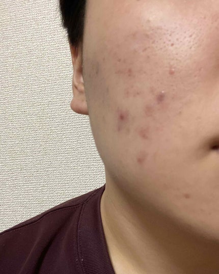 薬用クリーム洗顔/メンソレータム アクネス/洗顔フォームを使ったクチコミ(2枚目)