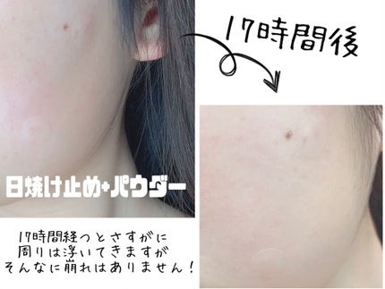 クリアパッチ/Angelab/にきびパッチを使ったクチコミ(5枚目)