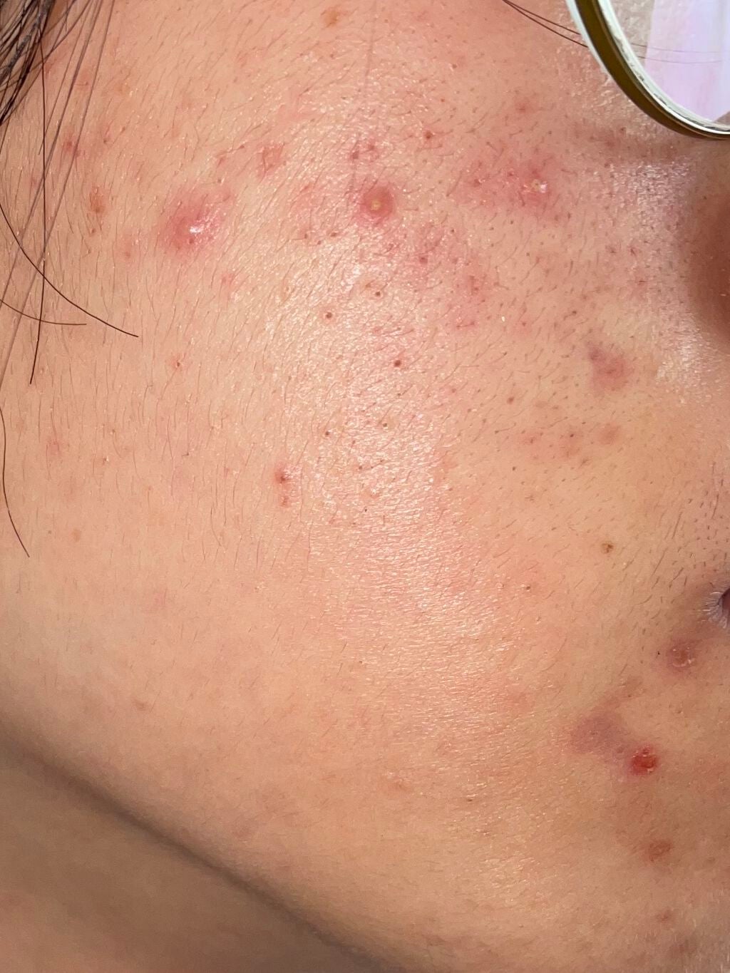 ハトムギ化粧水(ナチュリエ スキンコンディショナー R )/ナチュリエ/化粧水を使ったクチコミ(5枚目)