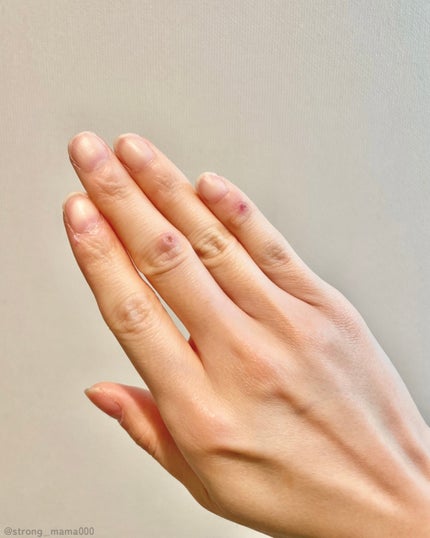 エイクリアスポットキュアパッチ/Dr.G/その他スキンケアを使ったクチコミ(6枚目)