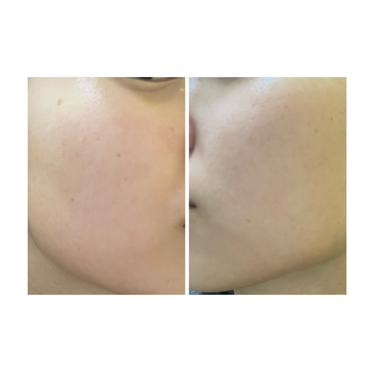 ぽむ on LIPS 「2023.9.13皮膚科に受診 エピデュオとヘパリン処方1枚目..」(3枚目)