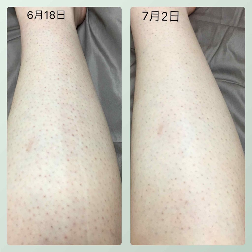 ケアノキュア(医薬品)/小林製薬/その他を使ったクチコミ(2枚目)