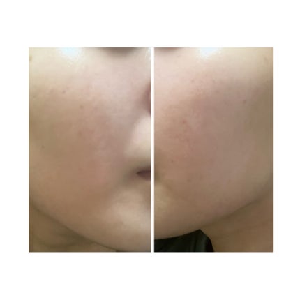 ぽむ on LIPS 「2023.9.13皮膚科に受診 エピデュオとヘパリン処方1枚目..」(4枚目)