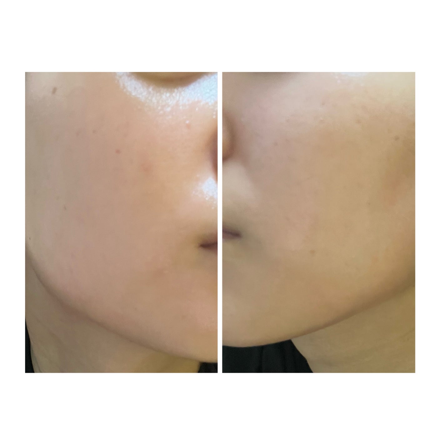 ぽむ on LIPS 「2023.9.13皮膚科に受診 エピデュオとヘパリン処方1枚目..」(4枚目)