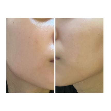 ぽむ on LIPS 「2023.9.13皮膚科に受診 エピデュオとヘパリン処方1枚目..」(4枚目)