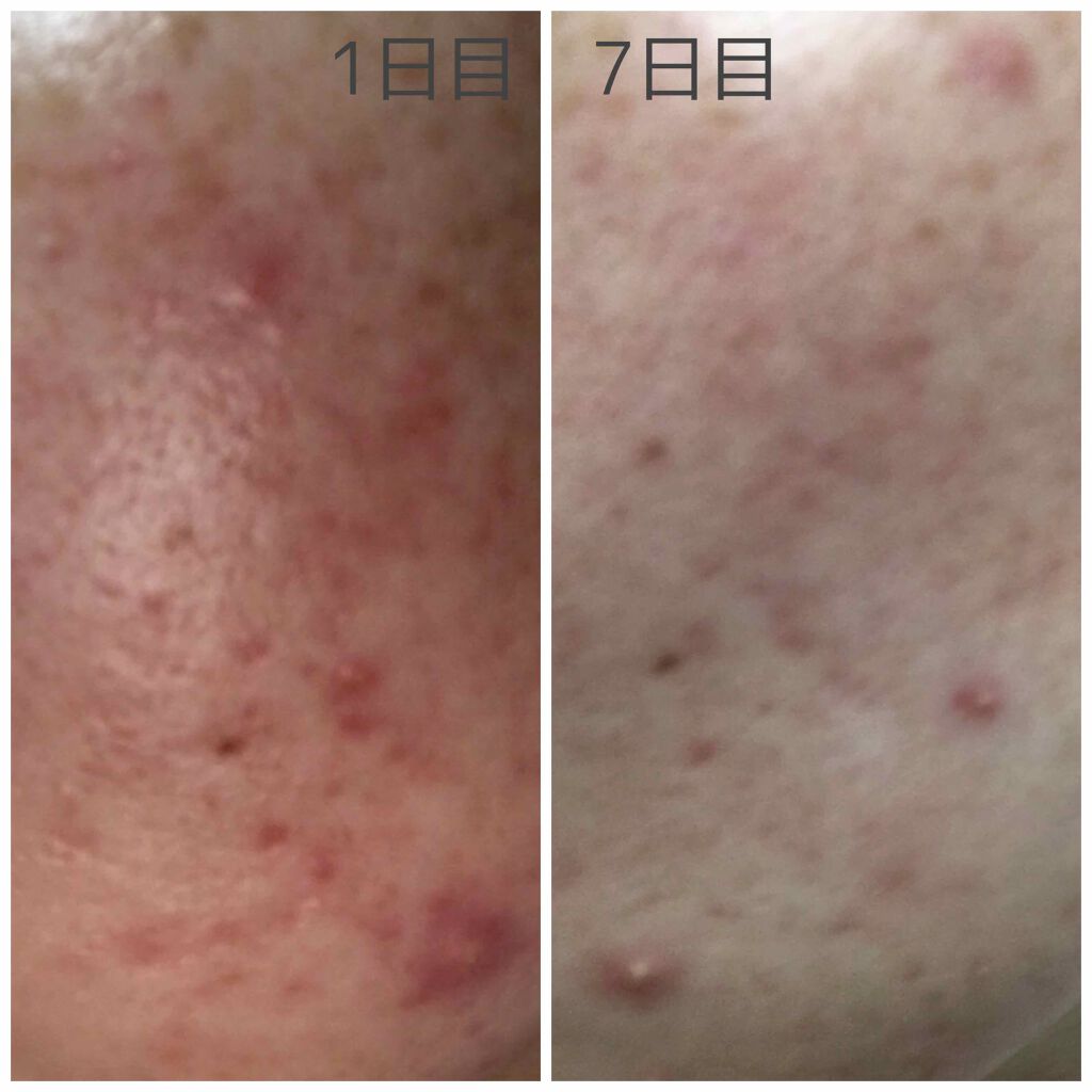 かな on LIPS 「アキュテインを飲み始めて7日目です。今日新しいニキビができまし..」(2枚目)