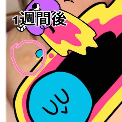 Nexcare/3M nexcare/にきびパッチを使ったクチコミ(3枚目)