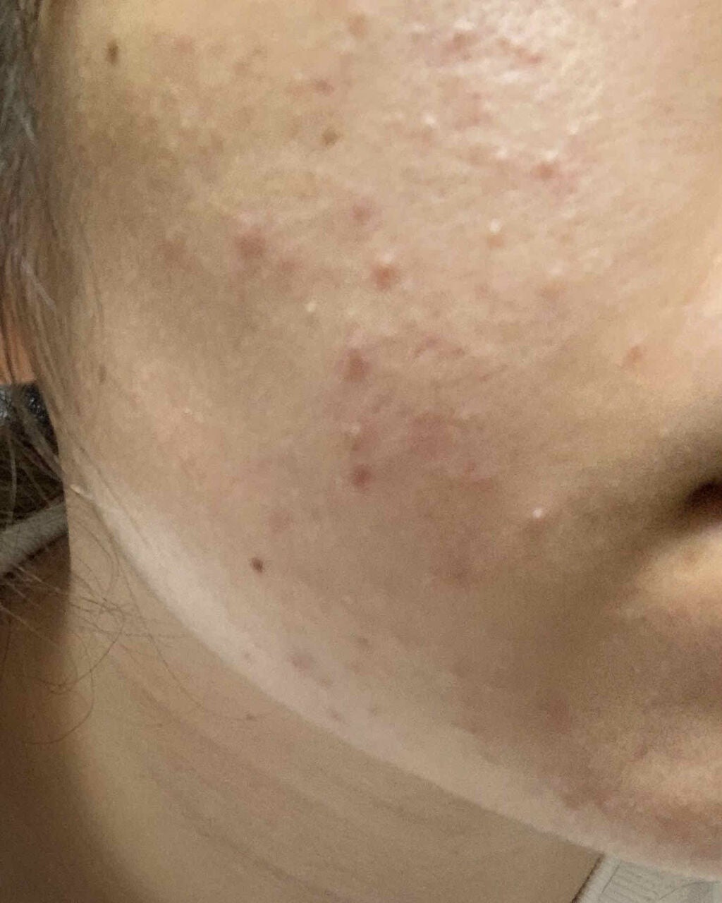 ロゼット洗顔パスタ アクネクリア/ロゼット/洗顔フォームを使ったクチコミ(1枚目)