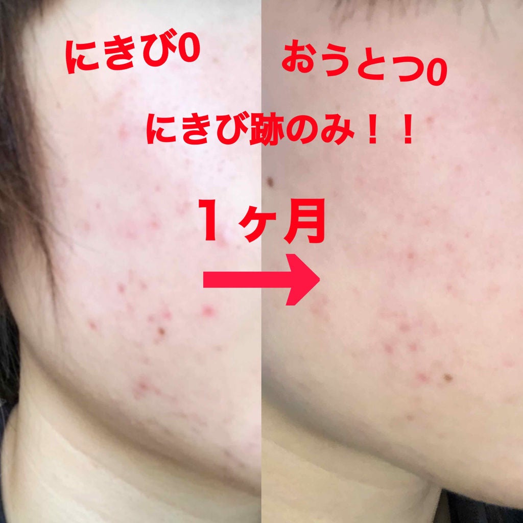 twinkle_sounds_hu6 on LIPS 「前回投稿したシカペアクリームと拭き取りパットを使って1ヶ月経ち..」(1枚目)