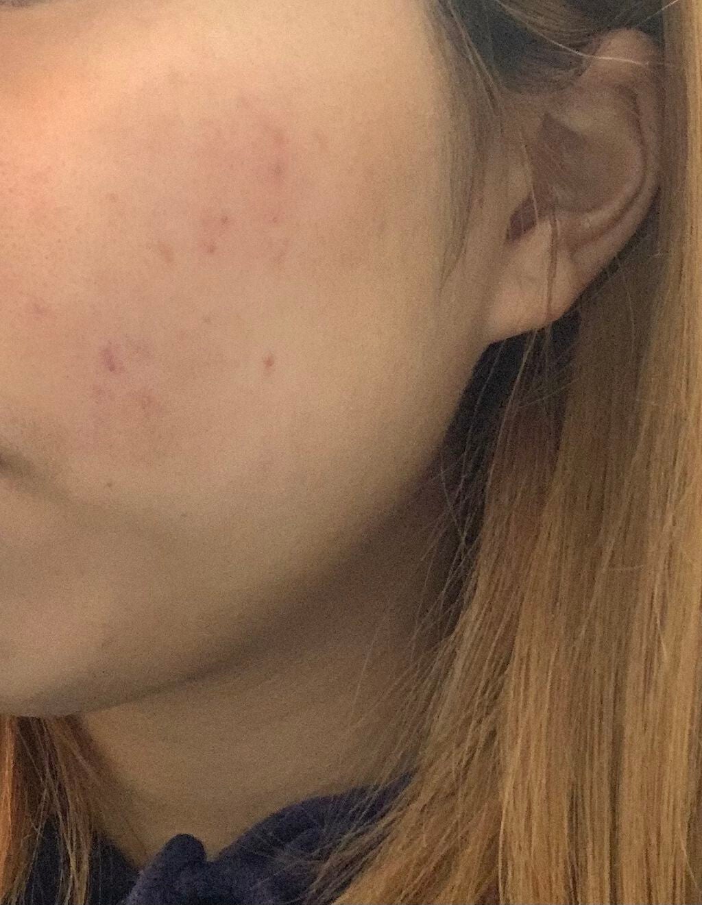 絢音 on LIPS 「デュアック12日目‼️まだ少し痒いですが、ヒリヒリ感をあまり感..」(1枚目)