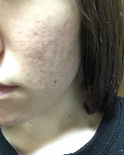 7 day Special Set プログラム3/b.glen/トライアルキットを使ったクチコミ(2枚目)