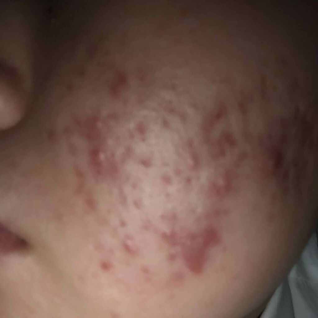 まいまい on LIPS 「初めての投稿です。私はいまひどいニキビで悩んでいます。ココ最近..」(5枚目)