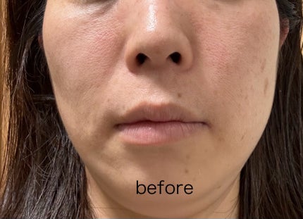 薬用ファーストエッセンス/ALBLANC/ブースター・導入液を使ったクチコミ(4枚目)