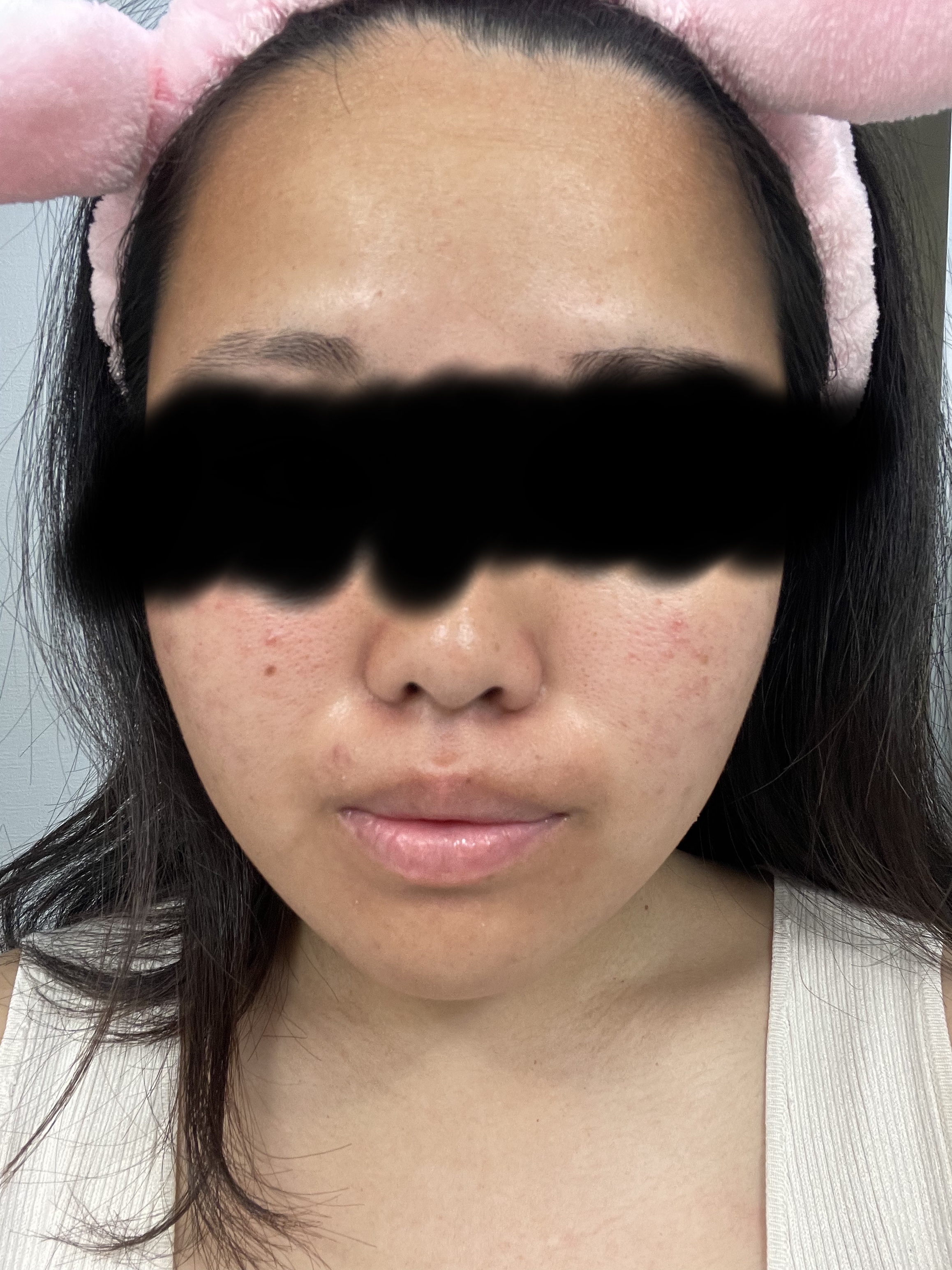 薬用 極潤 スキンコンディショナー/肌ラボ/化粧水を使ったクチコミ（3枚目）