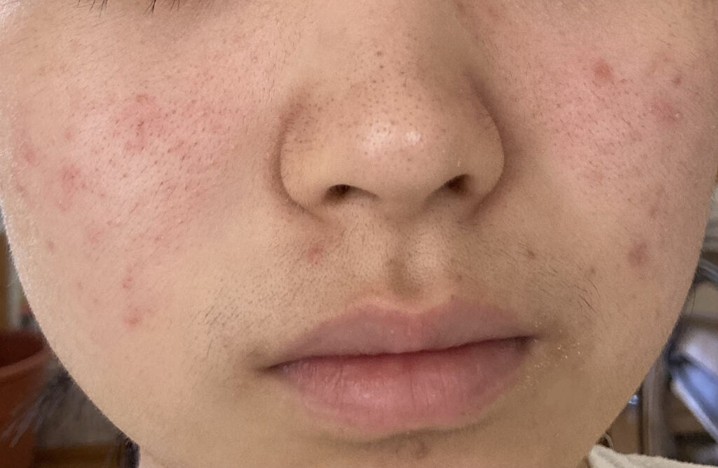 ハトムギエキス化粧水/プラチナレーベル/化粧水を使ったクチコミ（1枚目）