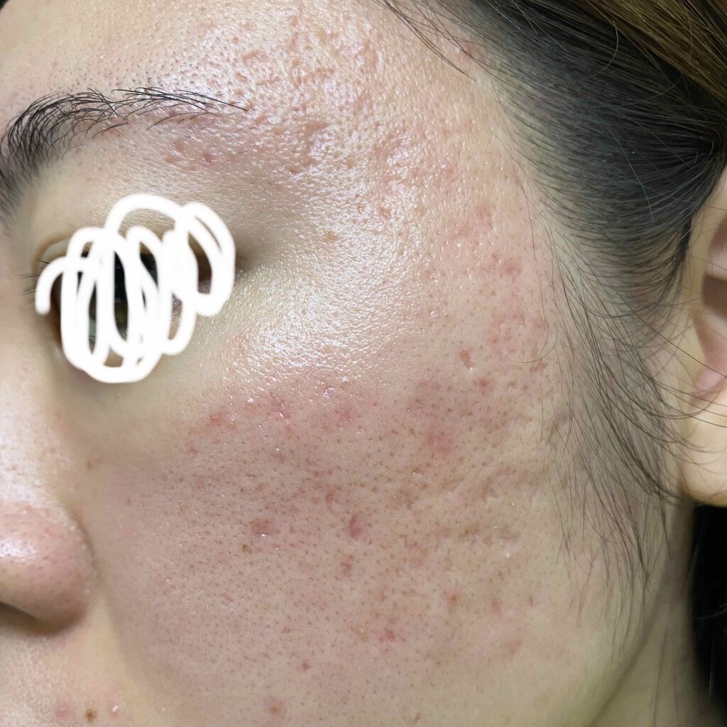 ロゼット洗顔パスタ アクネクリア/ロゼット/洗顔フォームを使ったクチコミ(2枚目)