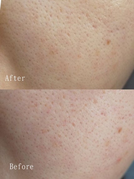 V エッセンス/unlabel/美容液を使ったクチコミ(2枚目)