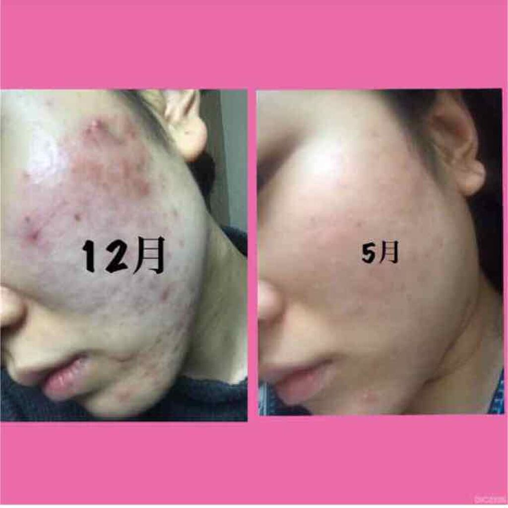 薬用 しみ 集中対策 美容液/メラノCC/美容液を使ったクチコミ(3枚目)