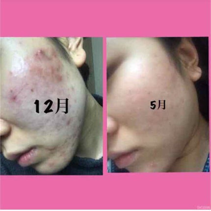 薬用しみ対策 美白化粧水/メラノCC/化粧水を使ったクチコミ(3枚目)