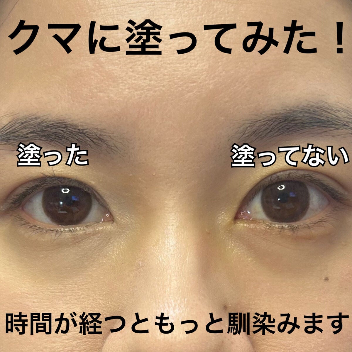 【旧】ディオールスキン フォーエヴァー スキン コレクト コンシーラー/Dior/リキッドコンシーラーを使ったクチコミ(4枚目)