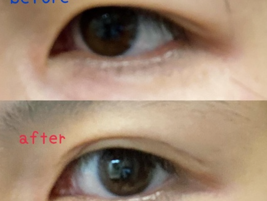 メザイク イージークリア 接着クリアタイプ/メザイク/二重まぶた用アイテムを使ったクチコミ(2枚目)