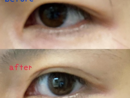 メザイク イージークリア 接着クリアタイプ/メザイク/二重まぶた用アイテムを使ったクチコミ(2枚目)