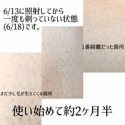 光美容器KE-NON(ケノン)/エムテック/家庭用脱毛器を使ったクチコミ(2枚目)