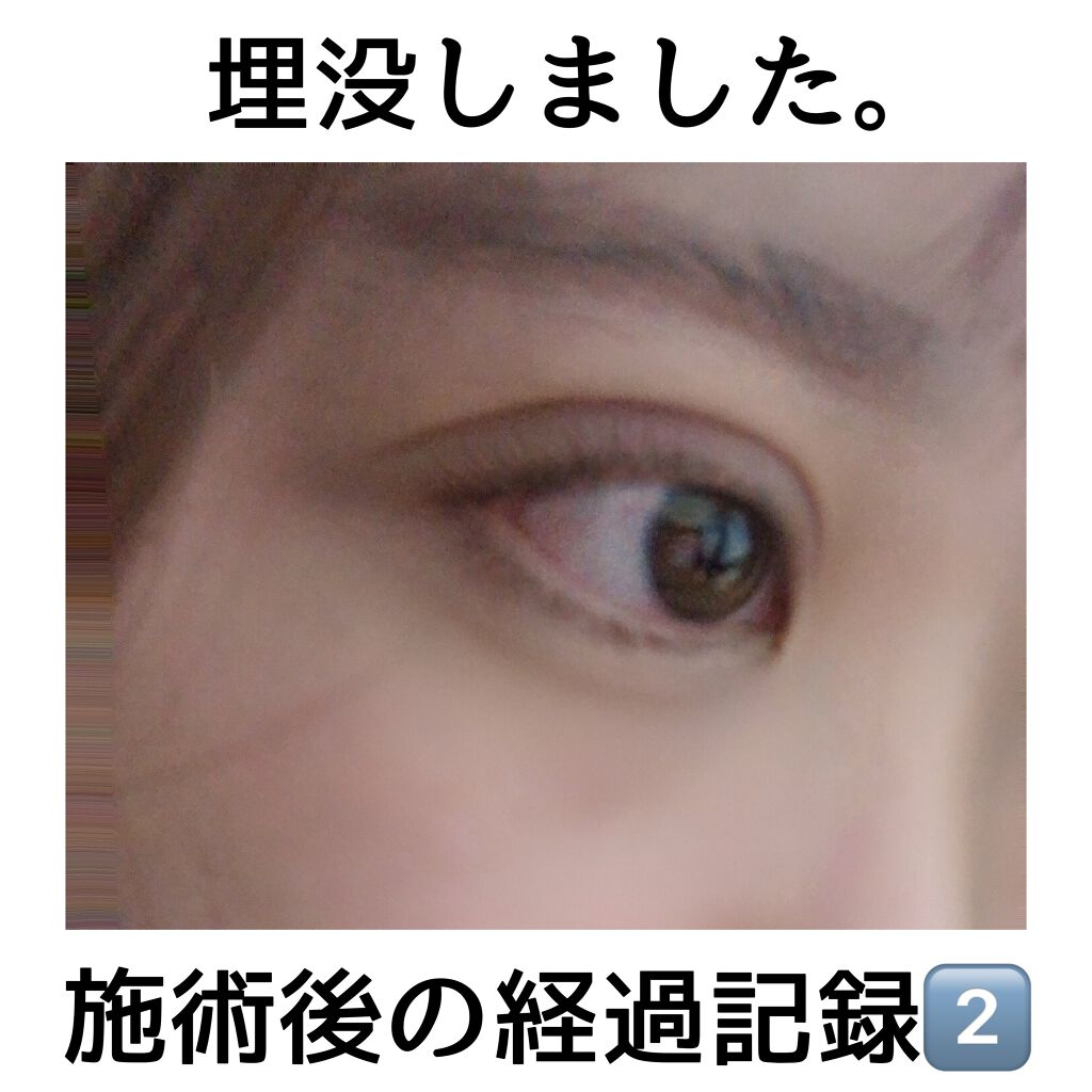 よも on LIPS 「『施術後のケア等も解説します』ご無沙汰しておりますよもですꪔ̤..」(1枚目)