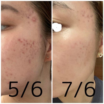 akari on LIPS 「〜ニキビ経過〜ニキビ治療を開始してから2ヶ月が経ちました!かな..」(1枚目)