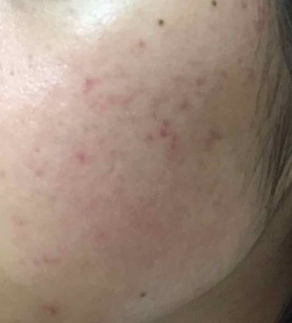 肌荒れ治すマン😕フォロバします💓 on LIPS 「肌荒れと戦う日記#10です🍒2枚目、4枚目、汚肌注意です😭😭😭..」(4枚目)