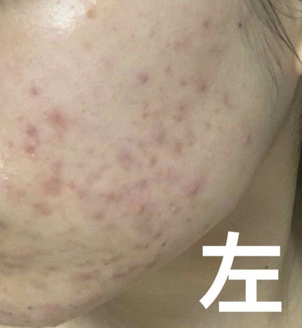 ベピオゲル/マルホ株式会社/その他を使ったクチコミ(2枚目)