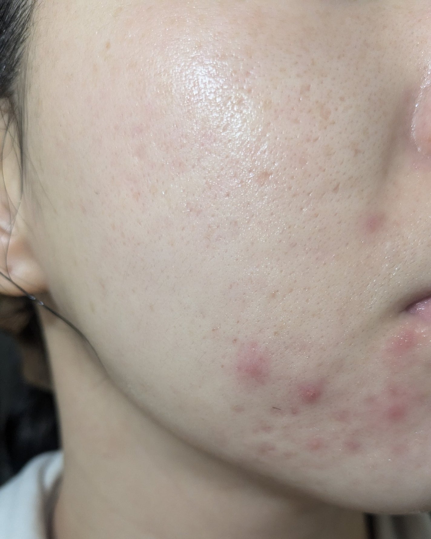 miina@汚肌工事録⚠️ on LIPS 「11/8の#汚肌工事録この頃、これでもまだ荒れ始めです😂..」(1枚目)