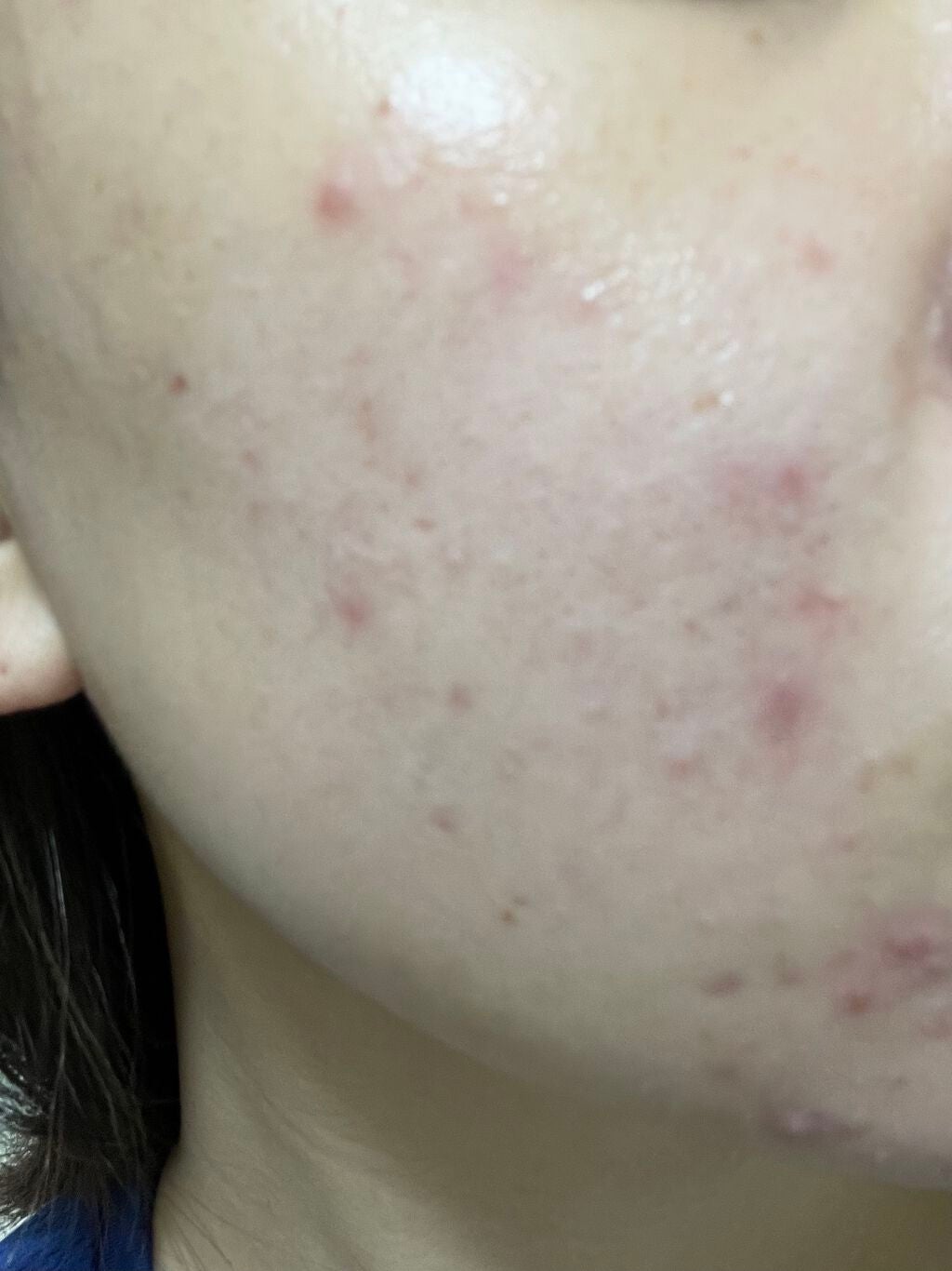 まままこ on LIPS 「ニキビゼロ肌を目指して〜6日目〜⚠️2枚目から肌画像ありスキン..」(2枚目)