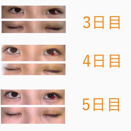 二重整形/その他を使ったクチコミ(3枚目)