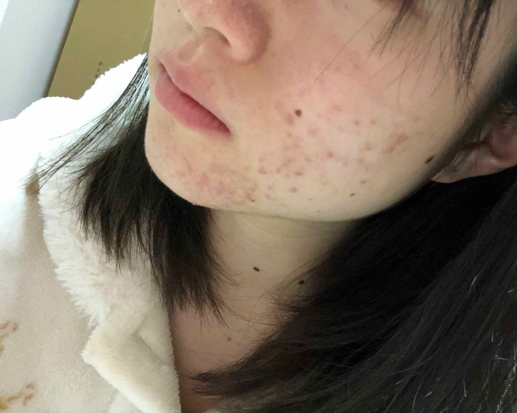 マンスリースキンケアプログラム(旧)/APEX/スキンケアキットを使ったクチコミ(4枚目)