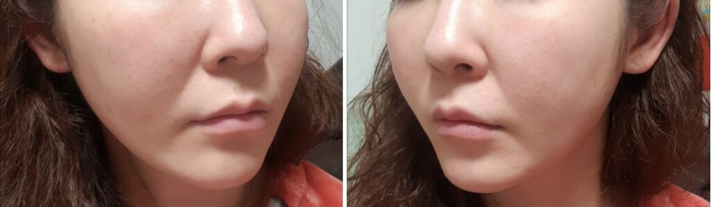 RECOVERING FLUID SERUM/BBACLAB/乳液を使ったクチコミ（3枚目）