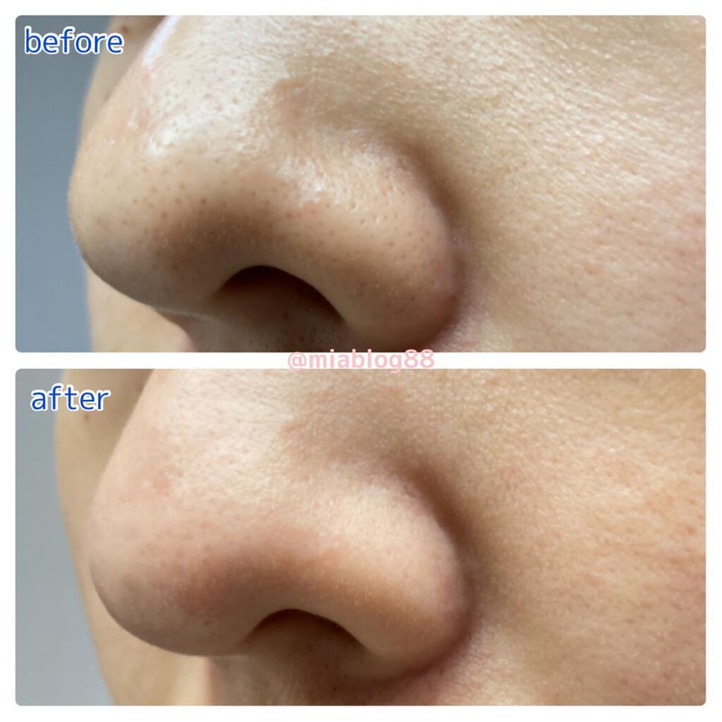 ブラック ヘッド ゼロ 2ステップ ノーズ パッチ/Dr.Althea/シートマスク・パックを使ったクチコミ(3枚目)