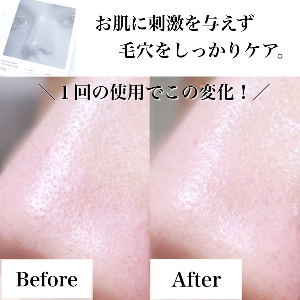 ブラックヘッドクリア2ステップノーズパッチ/DPU/シートマスク・パックを使ったクチコミ(1枚目)
