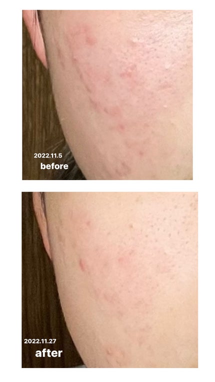 CICA デイリースージングマスク/VT/シートマスク・パックを使ったクチコミ(1枚目)