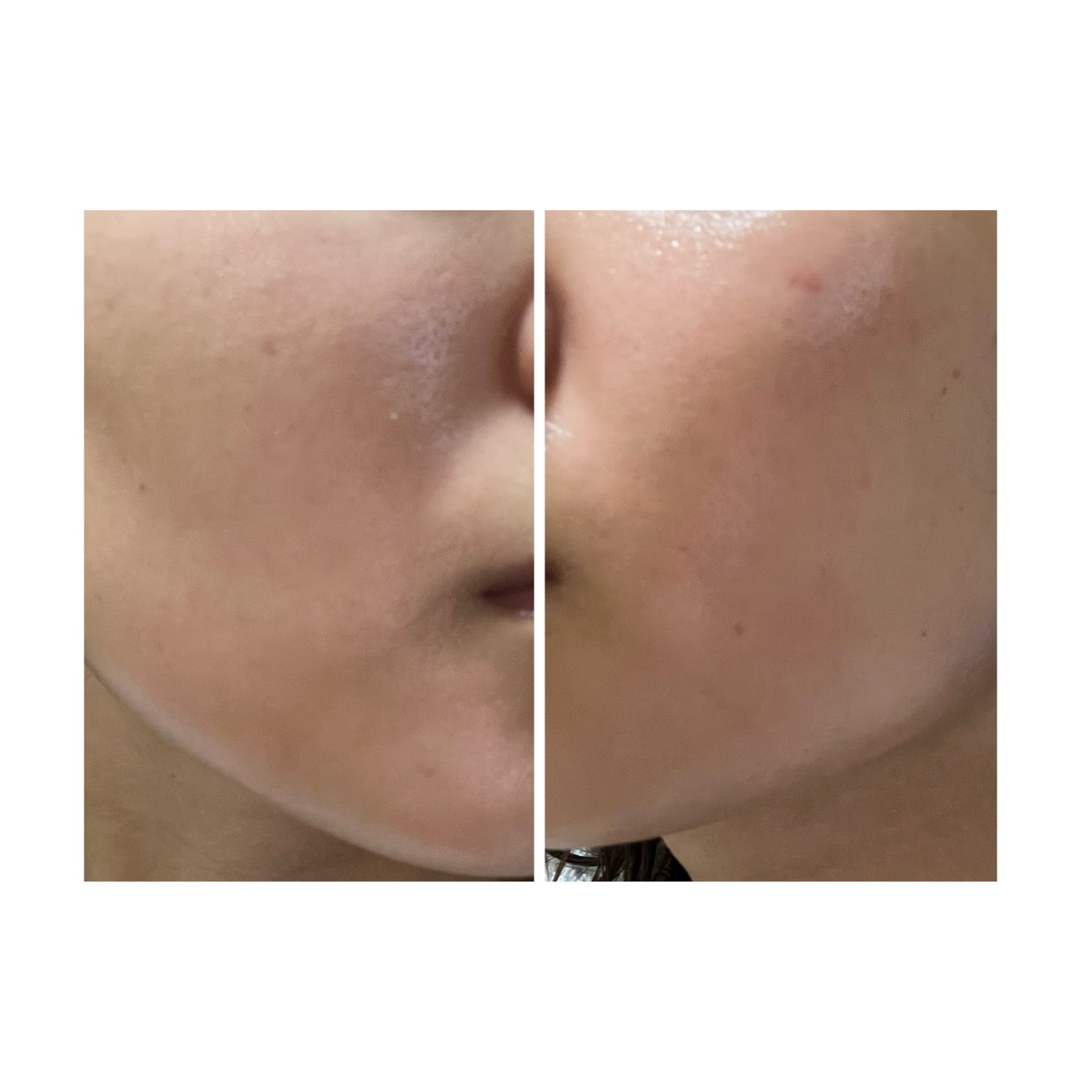 ぽむ on LIPS 「2023.9.13皮膚科に受診 エピデュオとヘパリン処方1枚目..」(2枚目)