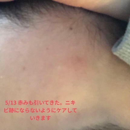 薬用 しみ 集中対策 美容液/メラノCC/美容液を使ったクチコミ(7枚目)