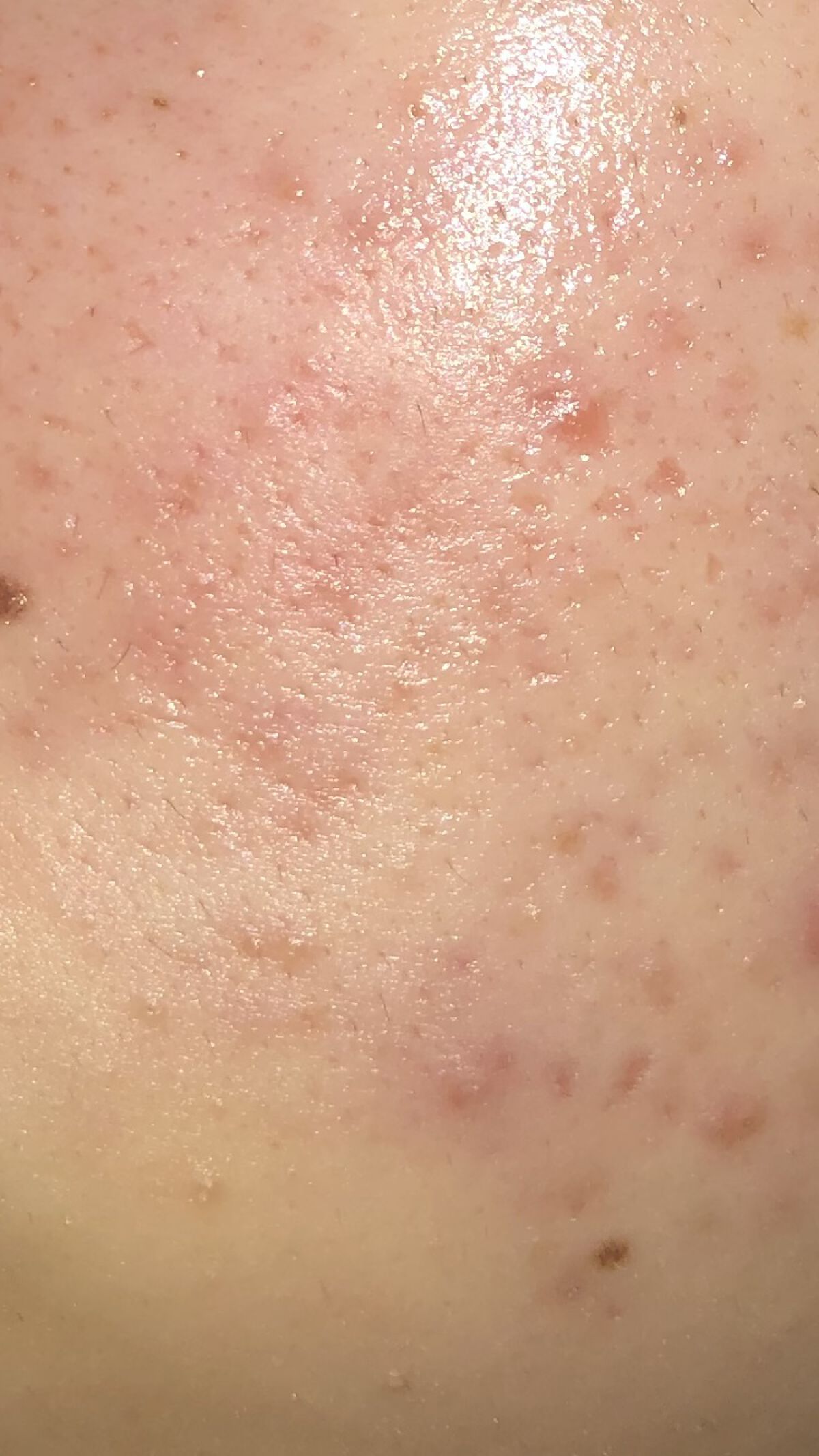 ティーツリーウォーター/ラッシュ/ミスト状化粧水を使ったクチコミ（3枚目）