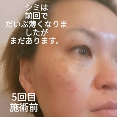 ビヨンセ奥二重向上委員長🥸LIPSパートナー🥳 on LIPS 「湘南美容クリニックで5回目のIPLシミ取り治療をしてきました！..」（2枚目）