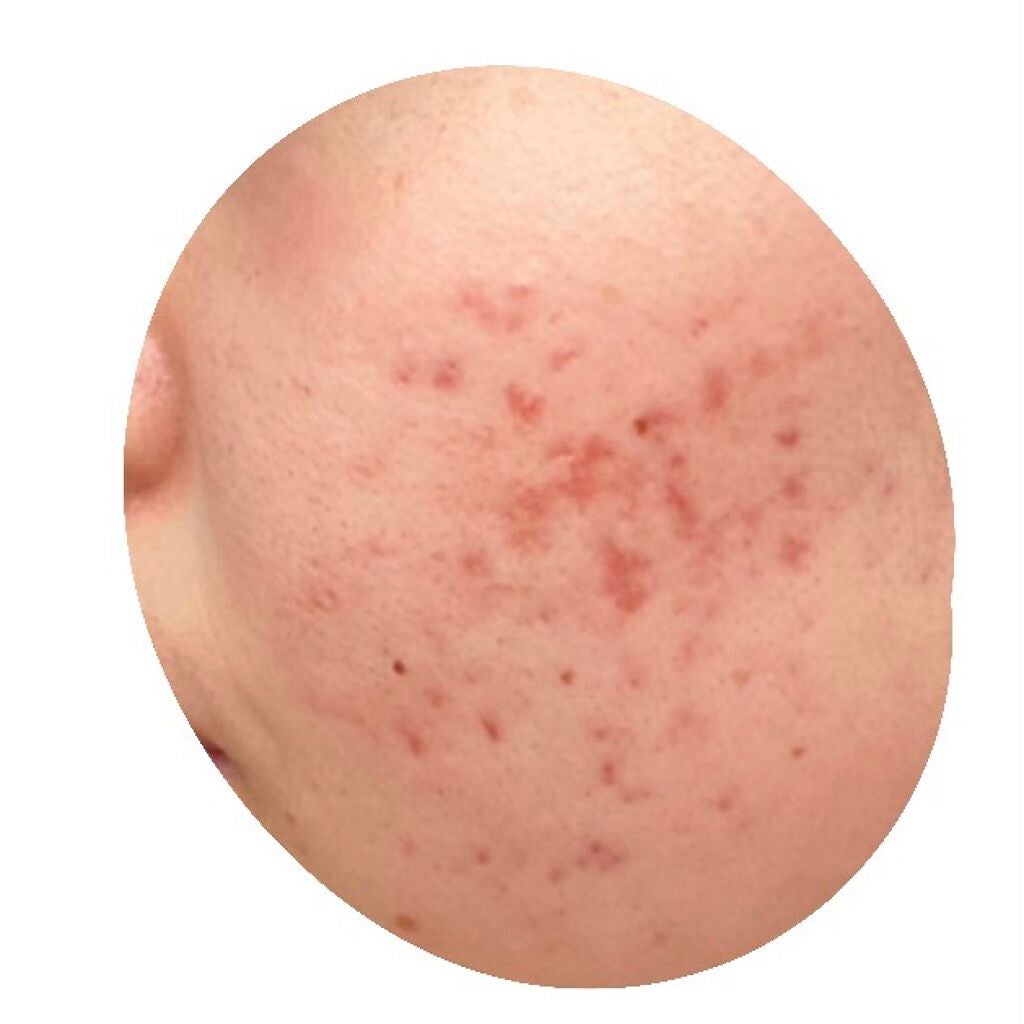 pink_sounds_dlm on LIPS 「赤みがひどい。写真でもわかるくらい毛穴が汚い。毛穴が開いている..」(2枚目)