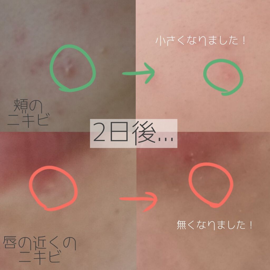 ゼロスポットパッチ/Today’s Cosme/にきびパッチを使ったクチコミ(3枚目)